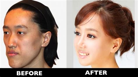 A standout amongst the most renowned instances of terrible plastic surgery turned out badly, Hang Mioku, a 48 year-old lady from South Korea, turned out to be so dependent on plastic surgery that she was left unrecognizable after her fixation drove her to infuse cooking oil into her face. . Korean plastic surgery gone wrong